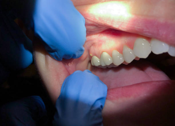 Best Emergency Treatment for Dental Infections or Abscesses in Silver Spring, MD